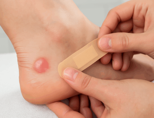 Správné ošetření puchýřů na nohou: Prevence komplikací a rychlé hojení